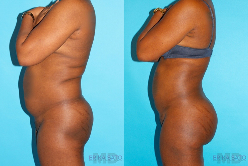 Brazilian Butt Lift case #4634