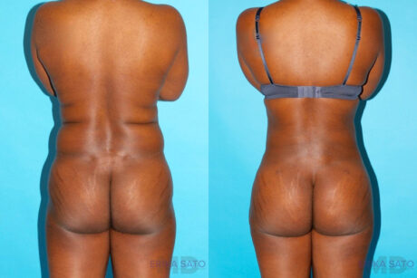 Brazilian Butt Lift case #4634