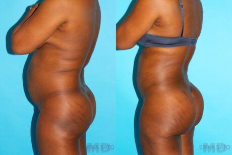 Brazilian Butt Lift case #4634