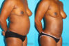 Brazilian Butt Lift case #4634 slider thumbnail