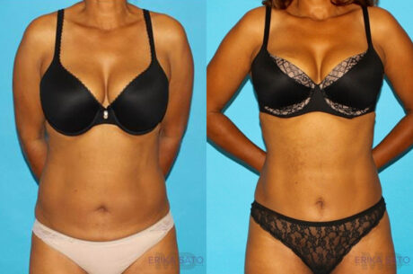 Tummy Tuck case #7232