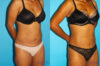 Tummy Tuck case #7232 slider thumbnail