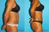 Tummy Tuck case #7232 slider thumbnail