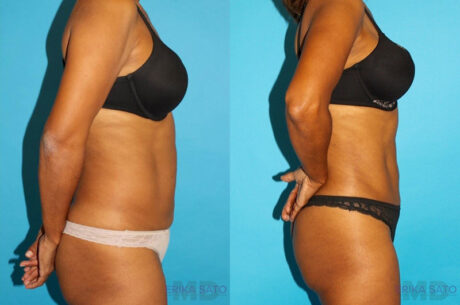 Tummy Tuck case #7232