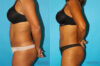 Tummy Tuck case #7232 slider thumbnail