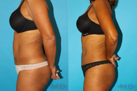 Tummy Tuck case #7232