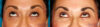 Blepharoplasty case #6888 slider thumbnail