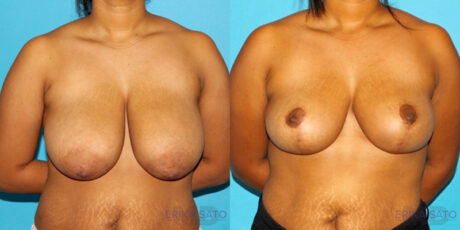 Breast Reduction case #7939