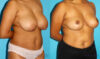 Breast Reduction case #7939 slider thumbnail