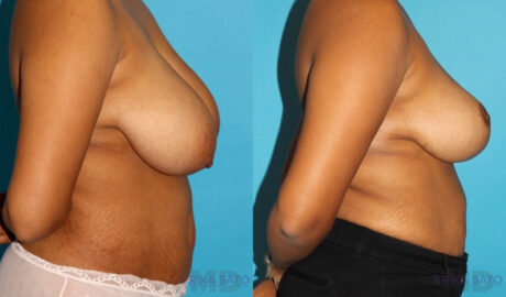 Breast Reduction case #7939