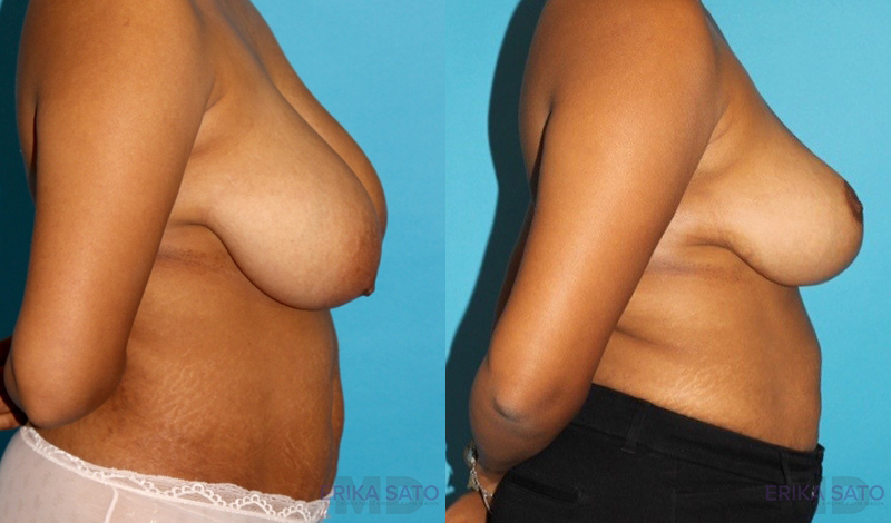 Breast Reduction case #7939