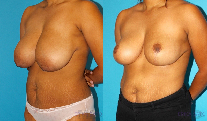 Breast Reduction case #7939