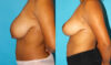 Breast Reduction case #7939 slider thumbnail
