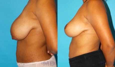 Breast Reduction case #7939