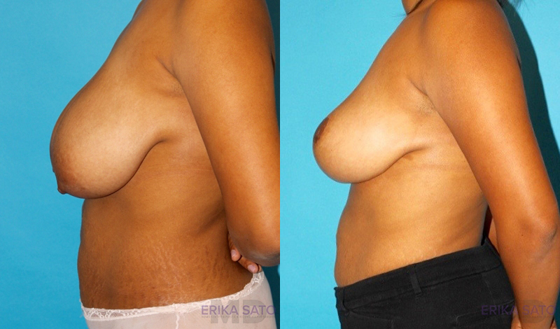 Breast Reduction case #7939