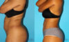 Liposuction case #5884 slider thumbnail