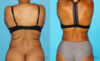 Liposuction case #5884 slider thumbnail