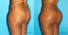 Brazilian Butt Lift case #4674 slider thumbnail