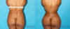 Brazilian Butt Lift case #4674 slider thumbnail