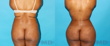 Brazilian Butt Lift case #4674