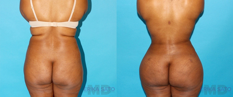 Brazilian Butt Lift case #4674