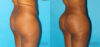 Brazilian Butt Lift case #4674 slider thumbnail