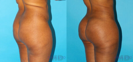 Brazilian Butt Lift case #4674