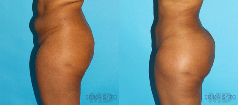 Brazilian Butt Lift case #4674