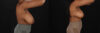Breast Reduction case #8031 slider thumbnail