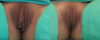 Labiaplasty case #5799 slider thumbnail