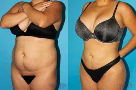 Brazilian Butt Lift case #4752