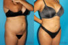 Brazilian Butt Lift case #4752 slider thumbnail