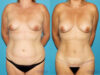 Mommy Makeover case #6505 slider thumbnail