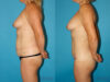 Mommy Makeover case #6505 slider thumbnail