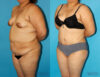 Tummy Tuck case #7088 slider thumbnail