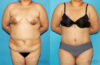 Tummy Tuck case #7088 slider thumbnail