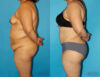 Tummy Tuck case #7088 slider thumbnail