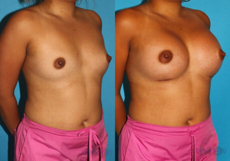 Breast Augmentation case #5659
