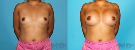 Breast Augmentation case #5659
