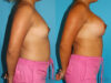 Breast Augmentation case #5659 slider thumbnail