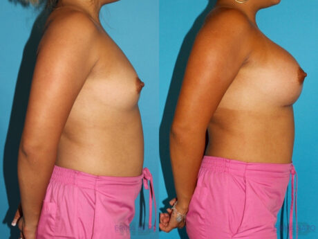 Breast Augmentation case #5659