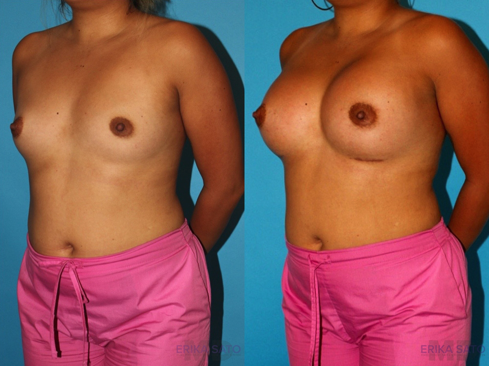 Breast Augmentation case #5659