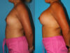 Breast Augmentation case #5659 slider thumbnail