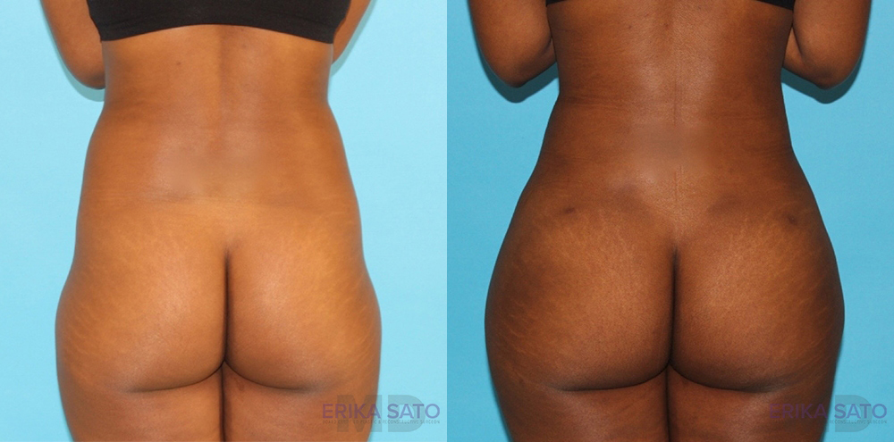 Brazilian Butt Lift case #4727
