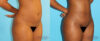 Brazilian Butt Lift case #4727 slider thumbnail
