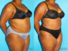 Liposuction case #5885 slider thumbnail