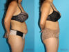 Tummy Tuck case #7166 slider thumbnail