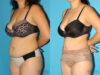 Tummy Tuck case #7166 slider thumbnail