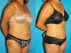 Tummy Tuck case #7233 slider thumbnail