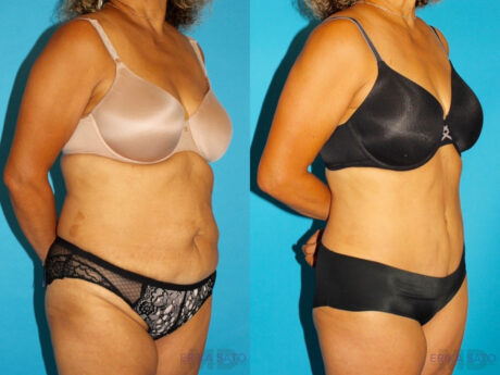 Tummy Tuck case #7233